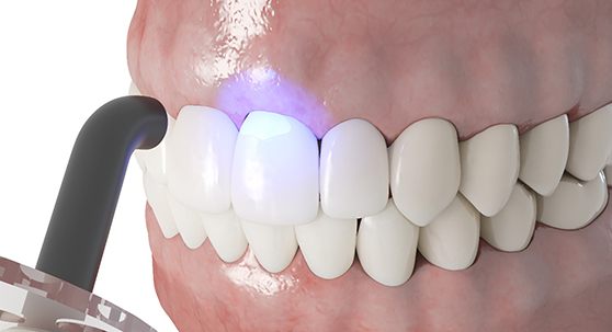 Illustration of teeth receiving cosmetic dental bonding in Lakewood, CO