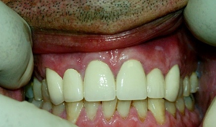 Flawless healthy smile after cosmetic dentistry