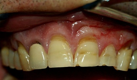 Damaged and decayed smile before cosmetic dentistry