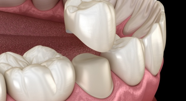 Animated smile during dental crown placement