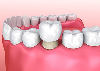 3D render of a dental crown