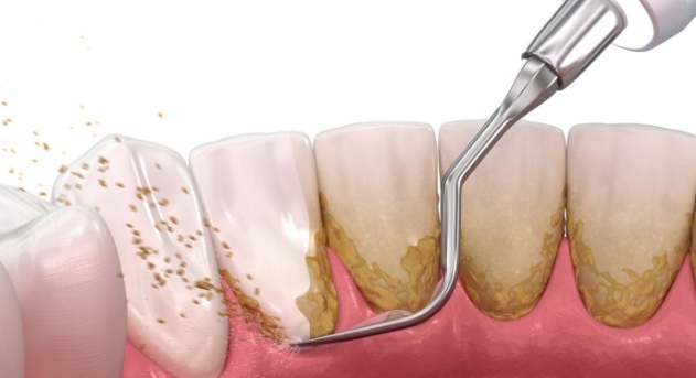 Animated smile during scaling and root planing treatment