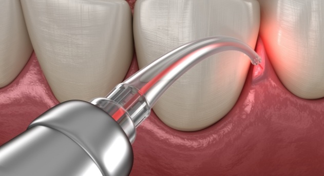 Animated smile during laser periodontal therapy