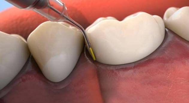 Animated smile during antibiotic therapy