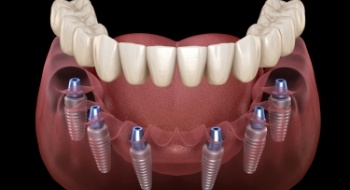 Animated smile during dental implant supported denture placement