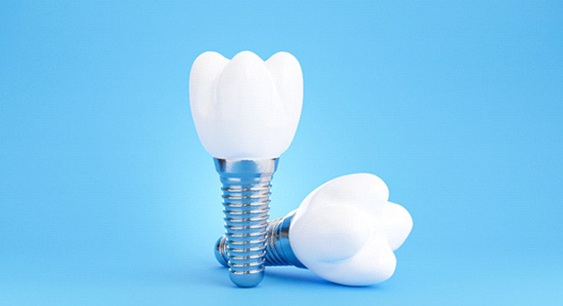 3D image of a dental implant