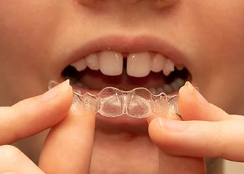 Close up of teen inserting upper aligner