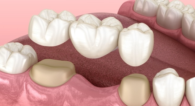 Animated smile during dental bridge placement