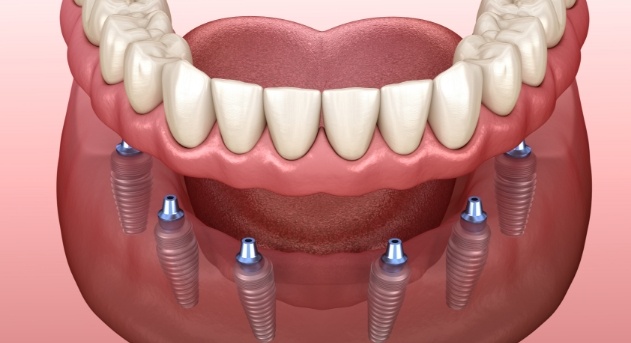 Animated smile during dental implant denture placement