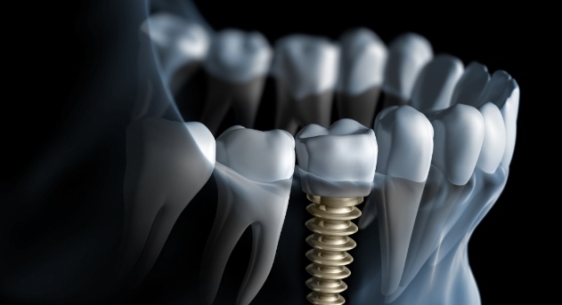 Animated smile with dental implant supported dental crown