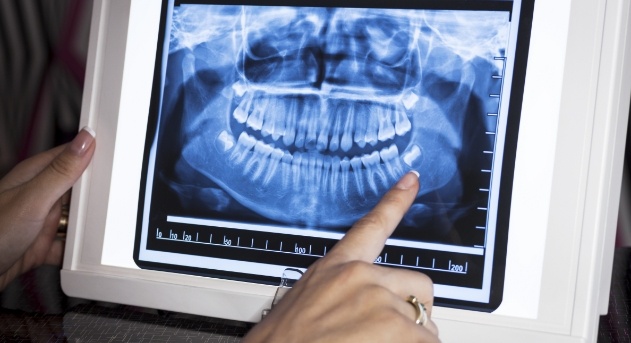 All digital x-rays on chairside computer screen