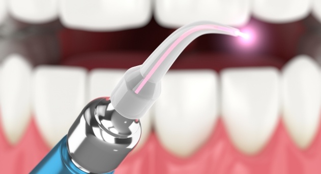 Soft tissue laser dentistry tool