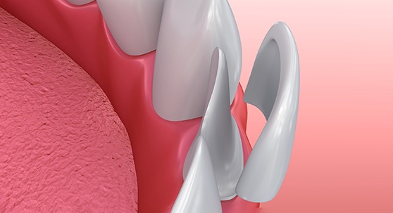 Model of veneer for lower tooth