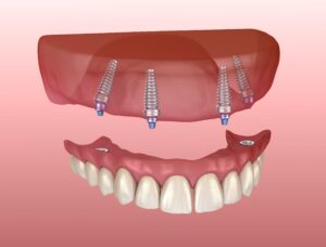 Model of implant supported upper denture